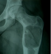 Unicameral bone cyst femur